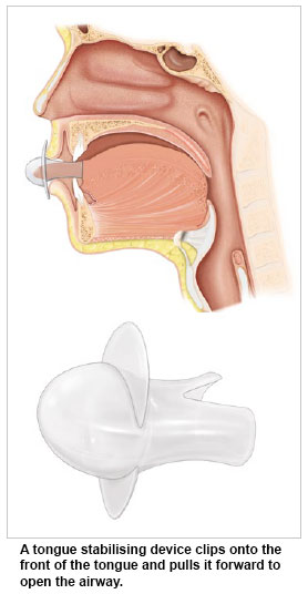 tongue stabilising device for obstructive sleep apnoea