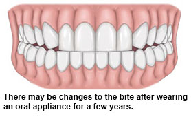 side effects of oral appliances for obstructive sleep apnoea