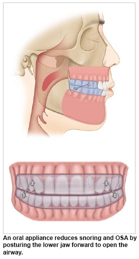advice for oral appliance wearers when ti comes to solving obstructive sleep apnoea
