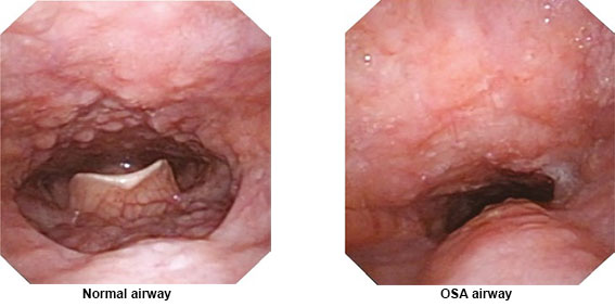 comparison between a normal airway and the airway with obstructive sleep apnoea