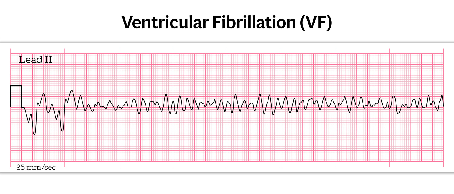 Ventricular fibrillation - SingHealth