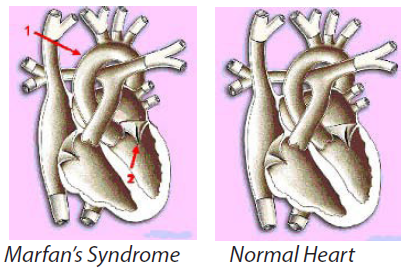 marfan's syndrome vs normal heart