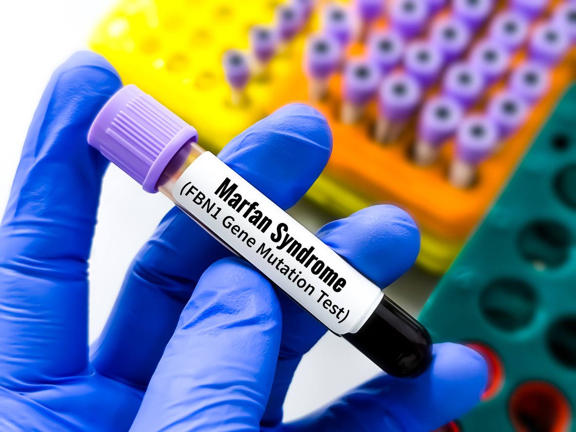  Marfan Syndrome Gene Mutation Test | SingHealth