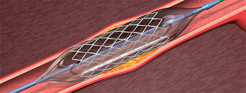procedure of coronary angioplasty
