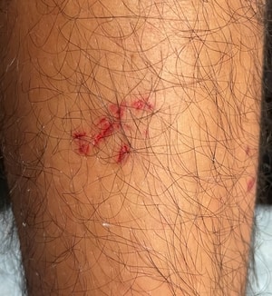 Snake bite - CGH